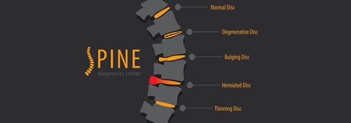 Chiropractic St Paul MN Treatment For Herniated Discs And Sciatica